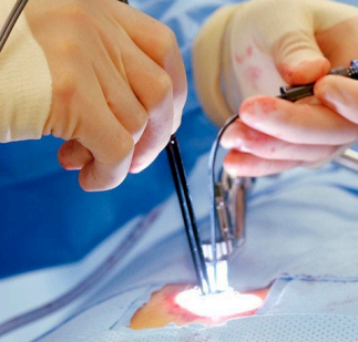 Treatment Options for Hemorrhoids